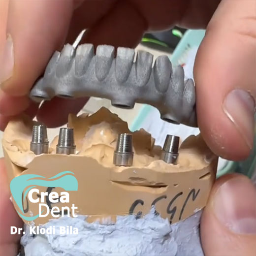 all-on-four-metallo-ceramica