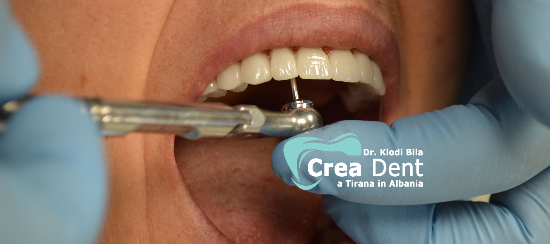 paziente-del-turismo-dentale-in-albania-della-clinica-crea-dent.