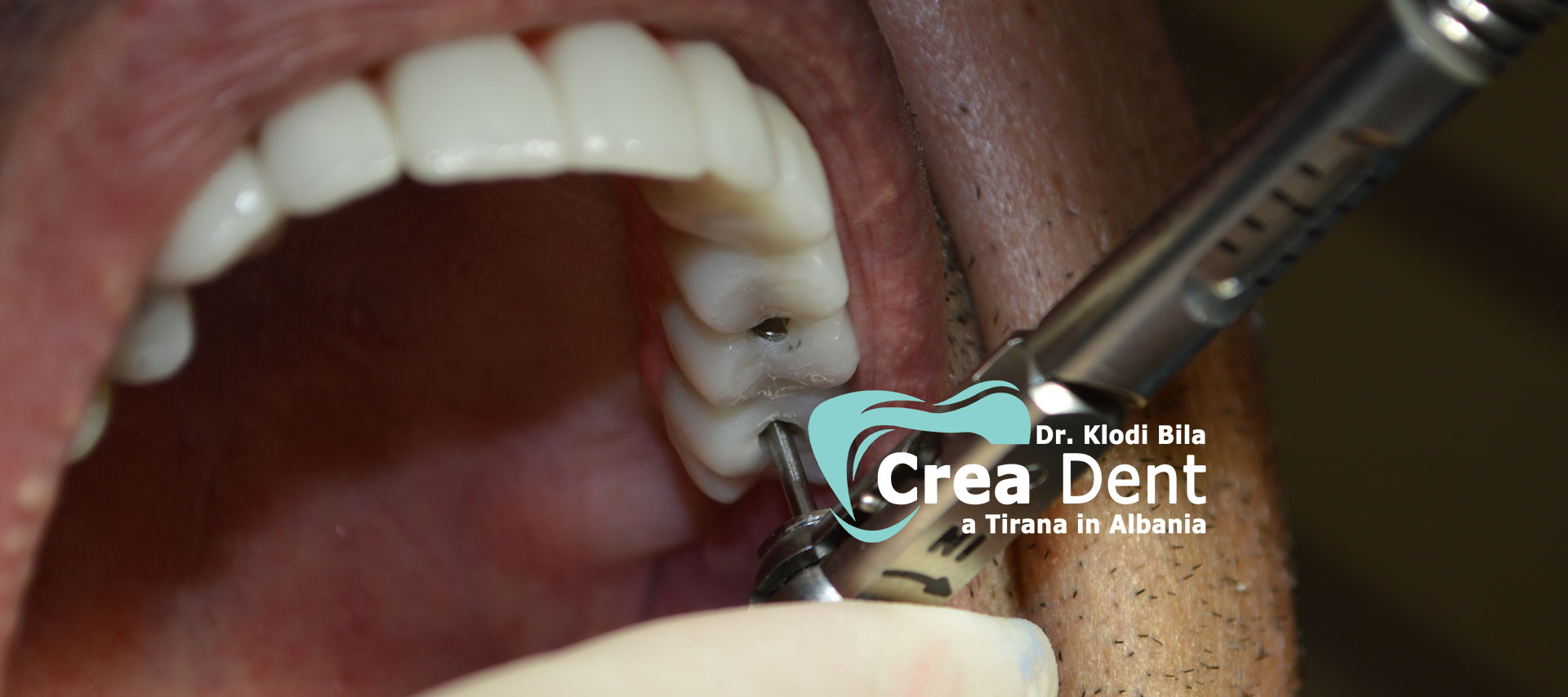 gruppo-di-pazienti-del-turismo-dentale-in-albania-del-dr-klodi-bila.