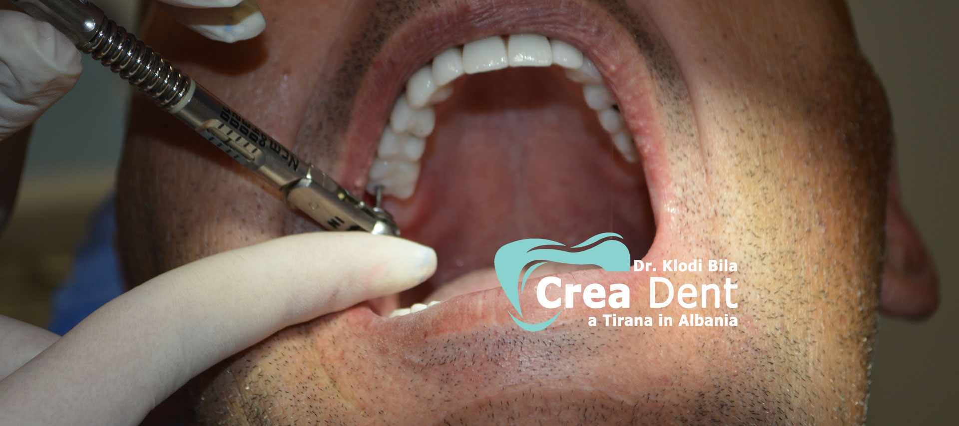 paziente-del-turismo-dentale-in-albania-della-clinica-crea-dent.