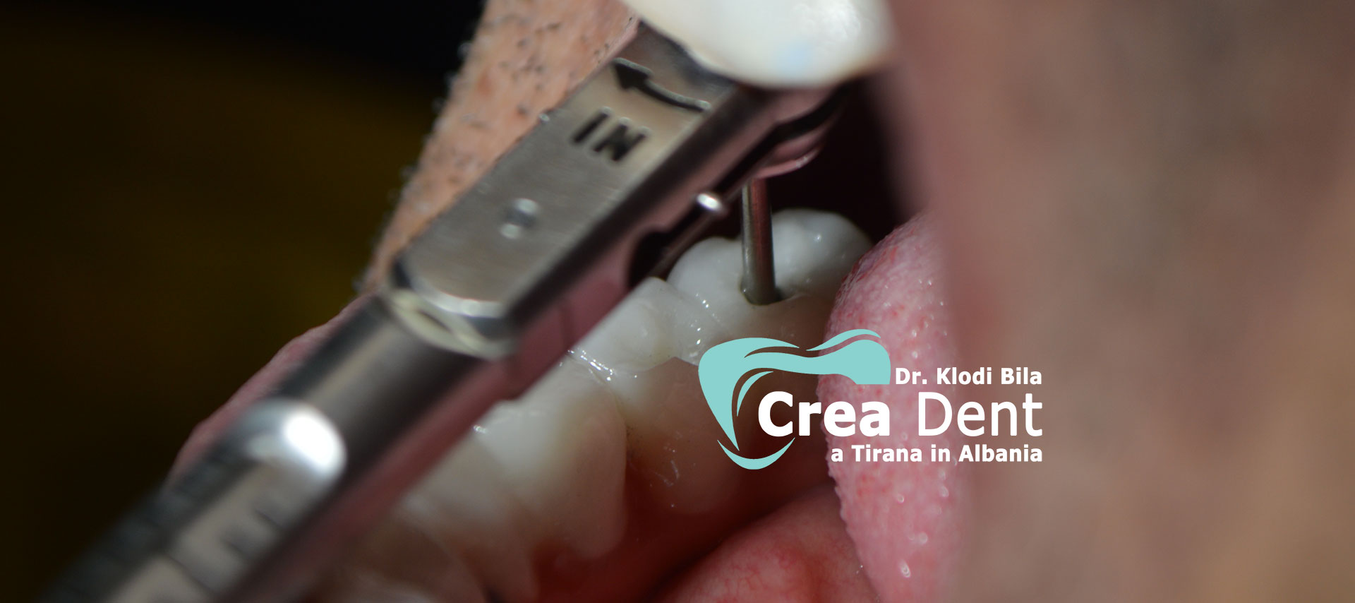 due-pazienti-del-turismo-dentale-con-il dr-klodi-bila.