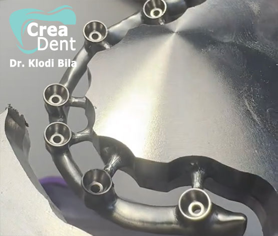 strutture-di-rinforso-su-impianti-dentali