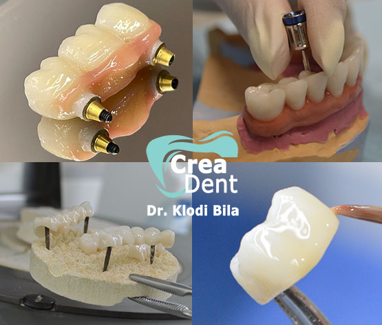 produzioni-nel-laboratorio-crea-dent