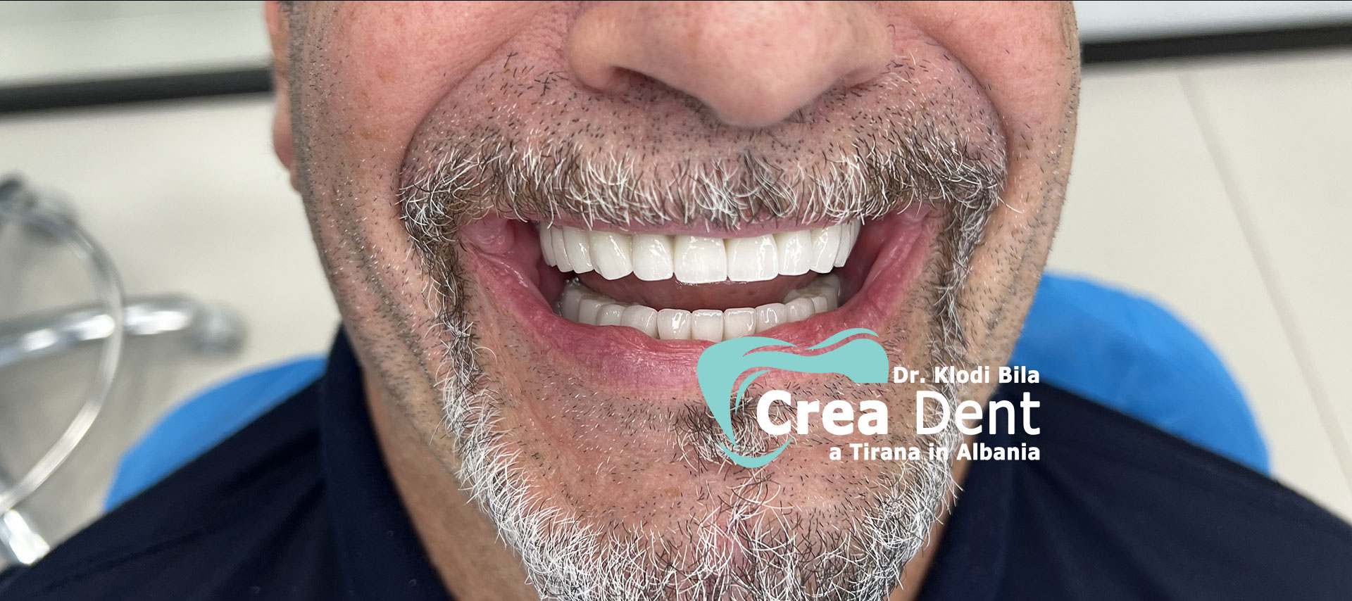 paziente-del-turismo-dentale-in-albania-della-clinica-crea-dent.