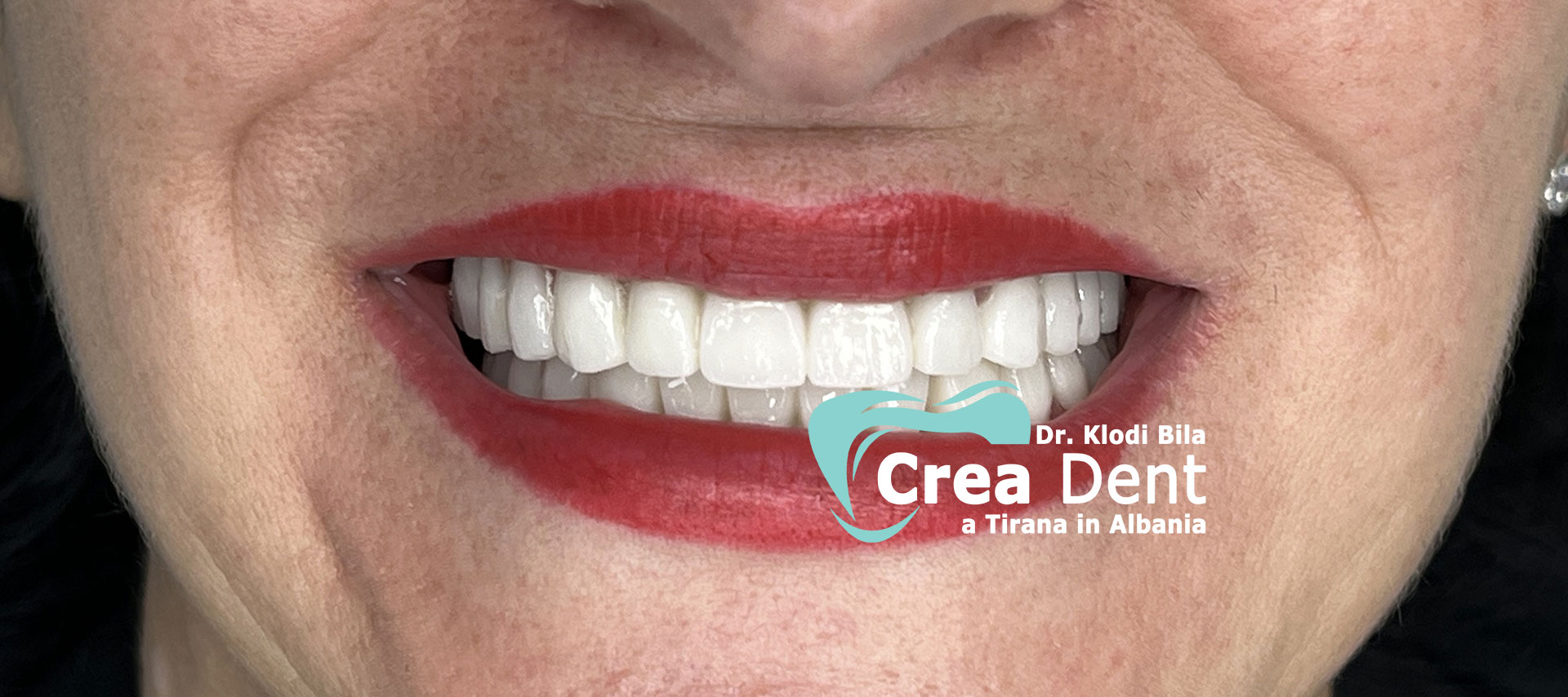 due-pazienti-del-turismo-dentale-con-il dr-klodi-bila.