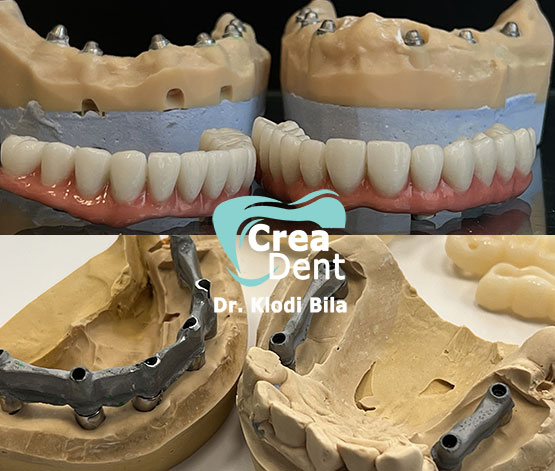 strutture-in-lega-per-protesi-dentali