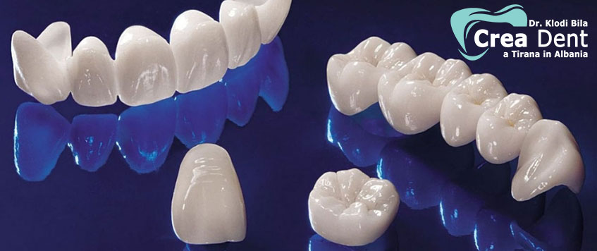 denti-corone-ponti-arcate-in-zirconio