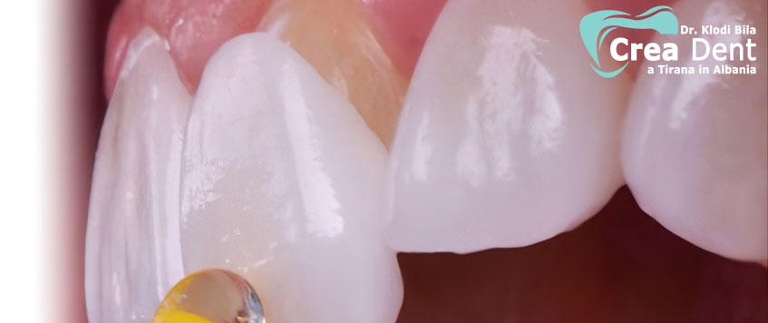 faccette-dentali-in-zirconio-o-ceramica-emax