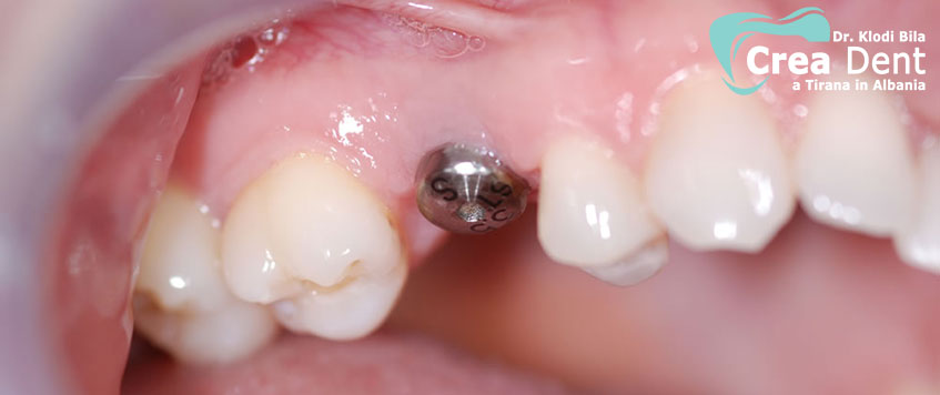 impianto-dentale-su-posizione-dente
