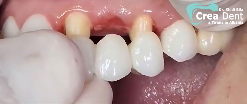 ponte-di-3-denti-montato-su-denti