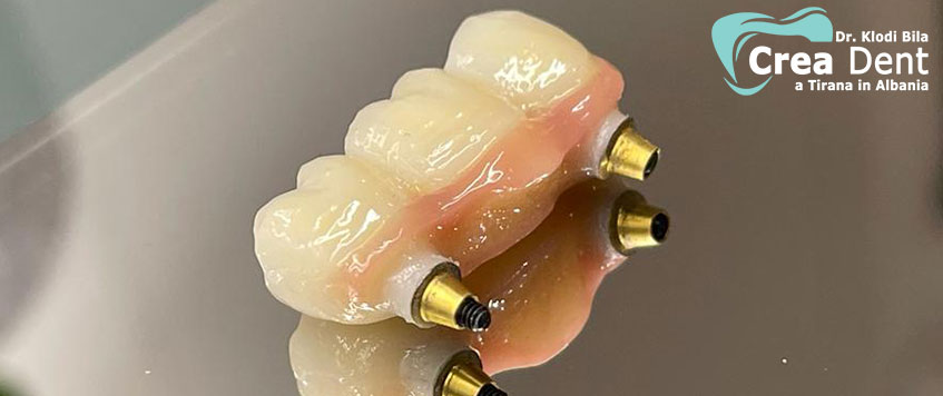 ponte-di-tre-denti-montato-su-impianti-dentali-crea-dent