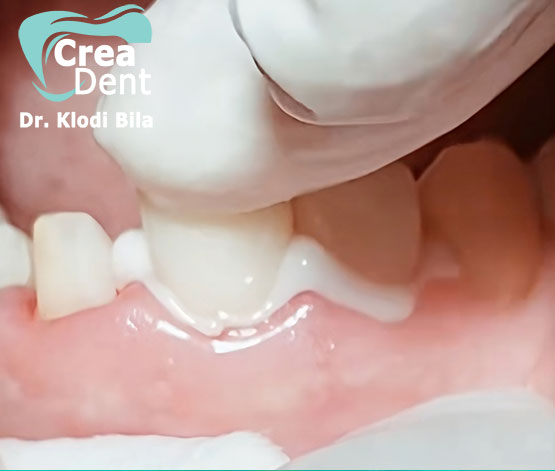 corone-su-denti-devitalizzati