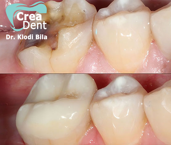 denti-devitalizzati-e-ricostruiti