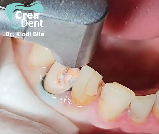 cura-canalare-devitalizzazione-dente