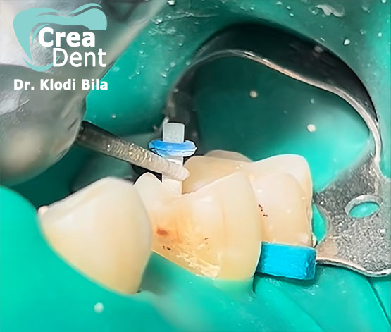 ricostruzione-denti