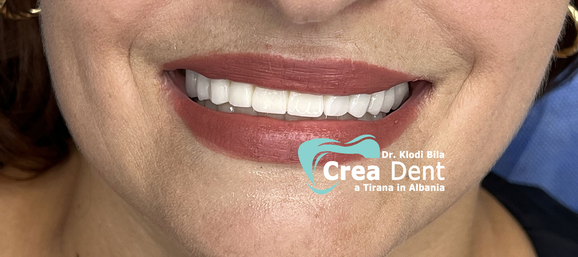 cure-dentali-Dr.-Klodi-Bila-dentista-a-Tirana-1.