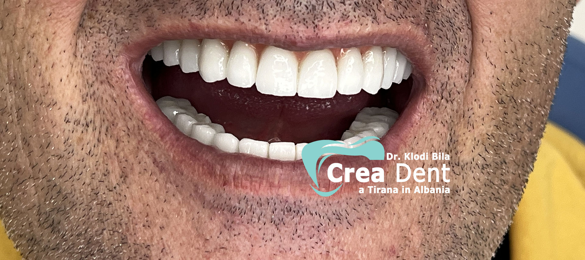 cure-dentali-Dr.-Klodi-Bila-dentista-a-Tirana-2.