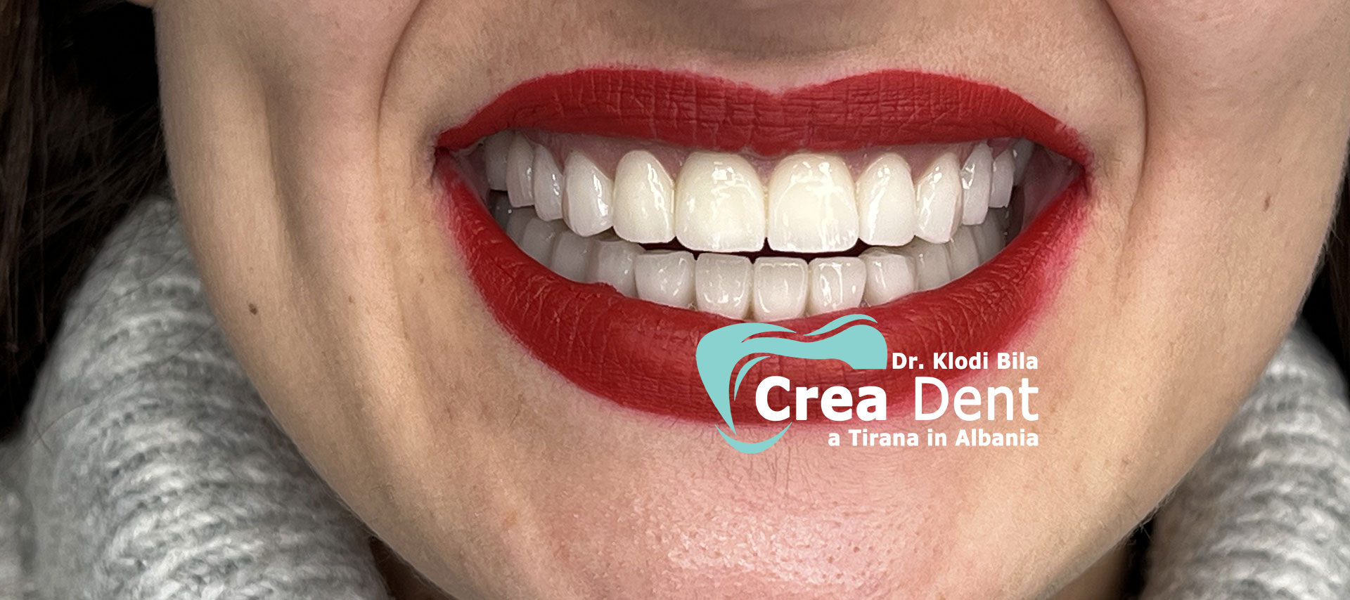 cure-dentali-Dr.-Klodi-Bila-dentista-a-Tirana-3.
