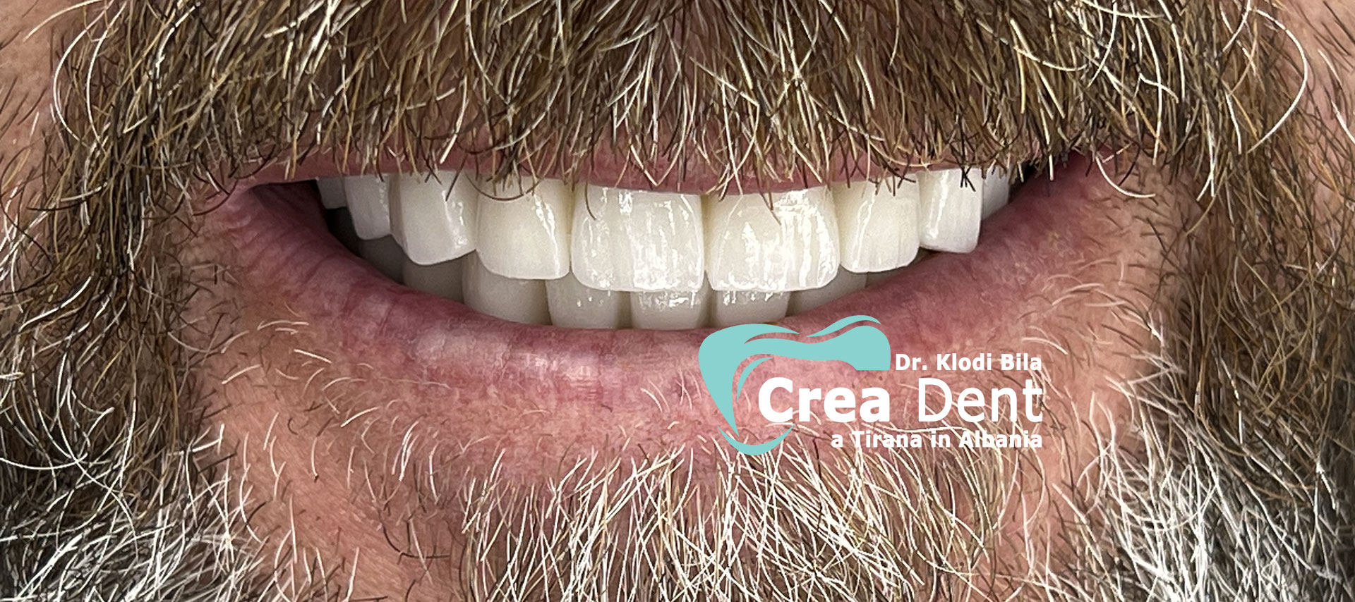 cure-dentali-Dr.-Klodi-Bila-dentista-a-Tirana-4.