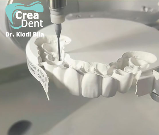 3-impianti-dentali