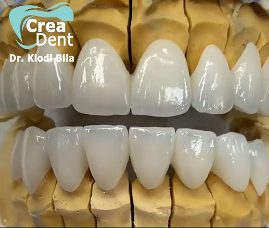 estetica-dentale-con-corone-in-zirconio