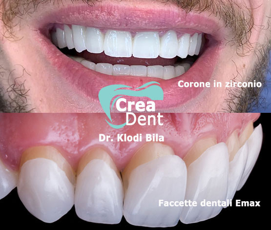 estetica-dentale-con-corone-in-zirconio