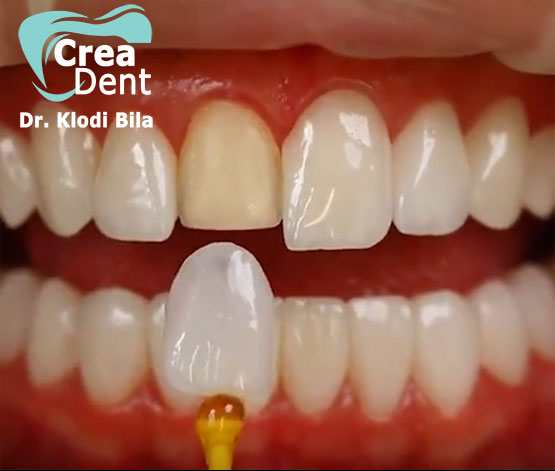estetica-dentale-con-faccette-dentali
