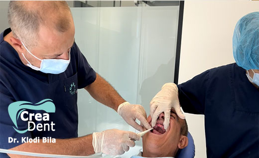 impronte-dentali-per-nuovi-denti
