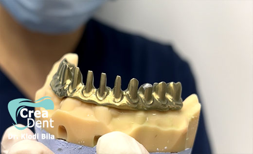 strutture-in-lega-per-arcate-dentali
