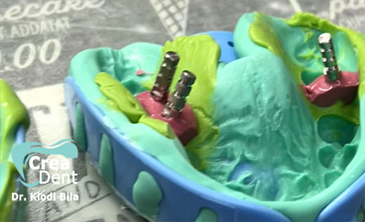 impronte-su-impianti-dentali