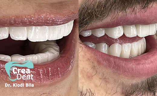 risultati-estetici-con-corone-in-zirconio