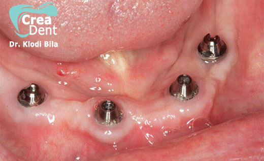 All-on-four-4-impianti-dentali-per-arcata
