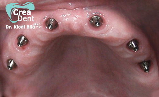 All-on-six-6-impianti-dentali-per-arcata
