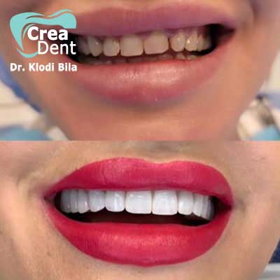 faccette-dentali-emax