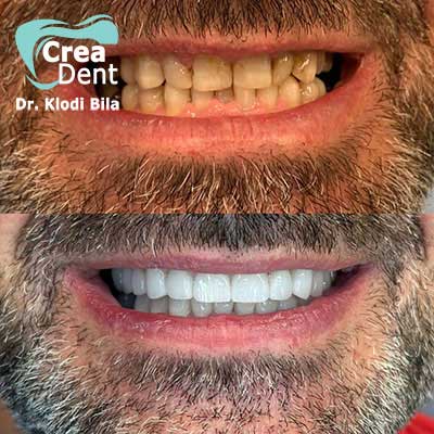 impianti-dentali-con-arcate-in-zirconio