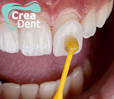 faccette-dentali-in-ceramica