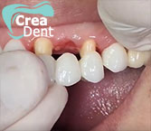 ponte-in-zirconio-su-denti