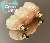 ponte-in-zirconio-su-impianti-dentali