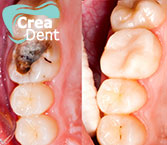 ricostruzione-dei-denti