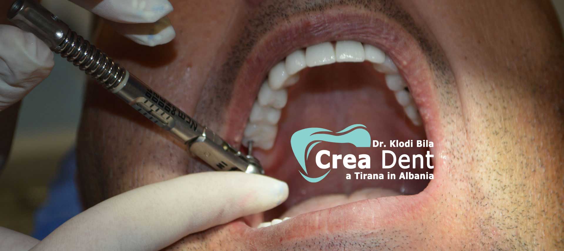 Arcate-dentali-in-zirconio-su-impianti-dentali.