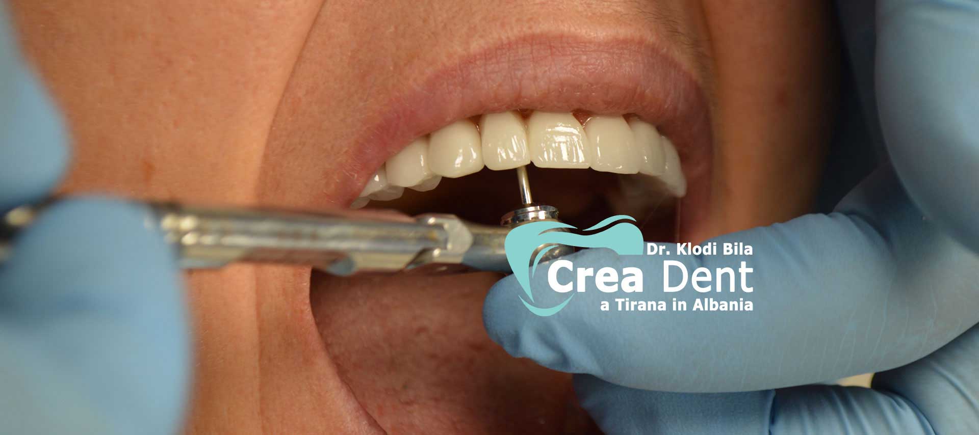 Estetica-dentale-con-denti-in-zirconio-e-faccette-dentali.