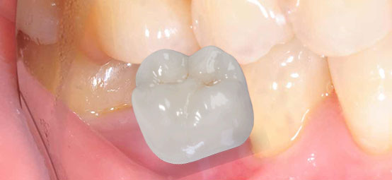 corona-su-dente
