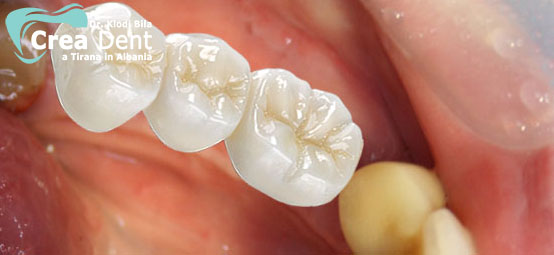 prezzo-ponte-con-3-denti