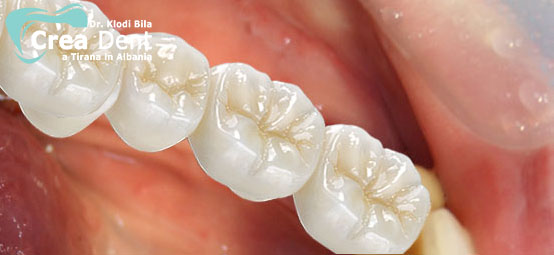 prezzo-ponte-con-4-denti