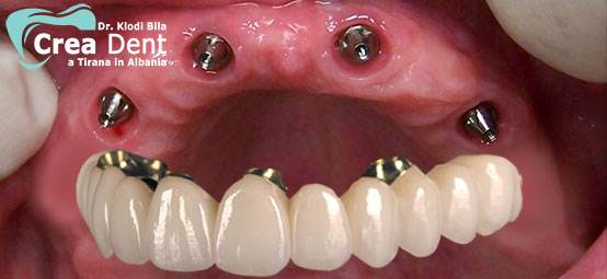 prezzo-all-on-four-4-impianti-dentali