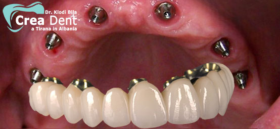 prezzo-all-on-six-6-impianti-dentali
