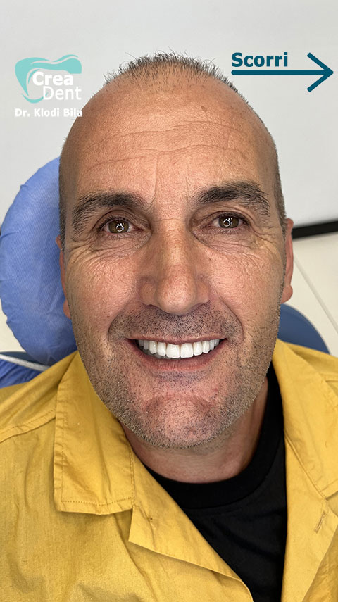 recensione-del-paziente-Antonio-della-clinica-crea-dent-del-dr-klodi-bila