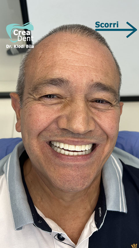 recensione-del-paziente-Nando-della-clinica-crea-dent-del-dr-klodi-bila