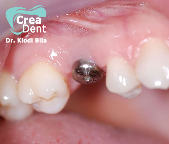 impianto-dentale