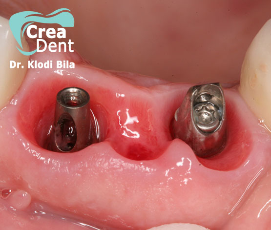 2-impianti-dentali